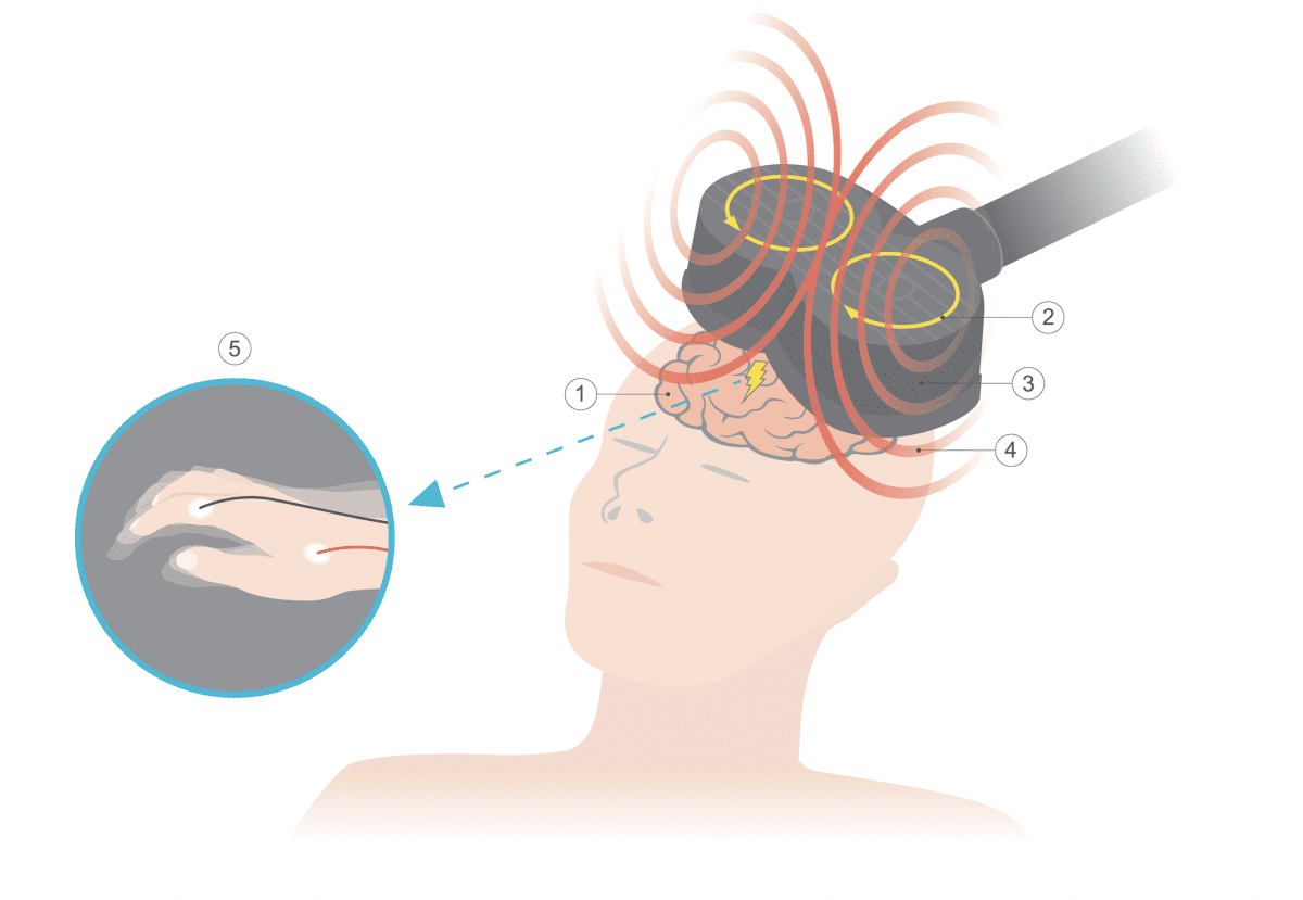 TMS for Schizophrenia Management