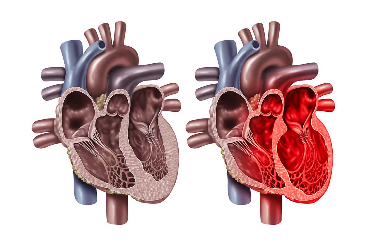 Substance Withdrawal and Takotsubo Cardiomyopathy